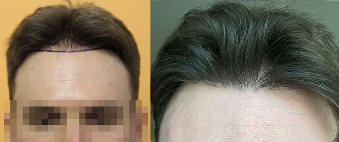 Dr.Bisanga, BHR Clinic, 1675 FUE, 0 - 13 Months photo