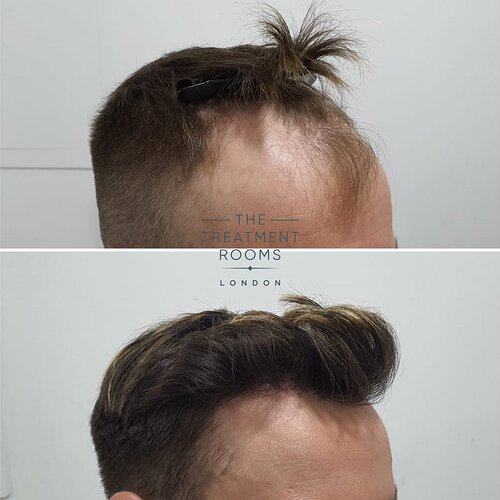 Receding hairline result- 1724 grafts FUE Hair Transplant photo