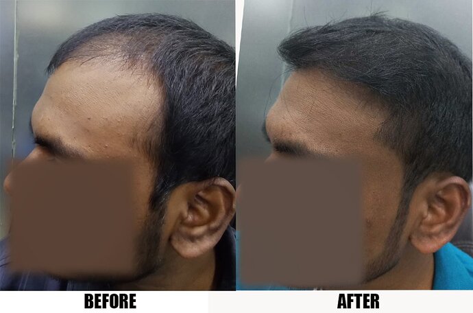 RA 139 - (3606 FUSE/Fue grafts) 1 year update photo