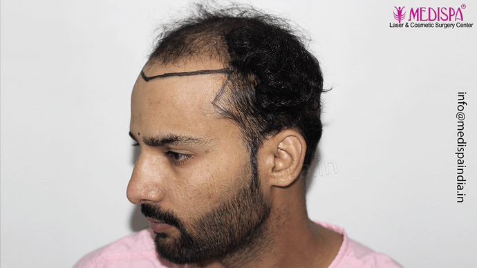 Dr. Suneet Soni - 4046 Grafts | 12-Month Result | Combination FUT + FUE + Beard photo