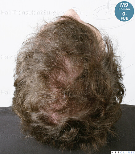 Dr. Jean Devroye, HTS Clinic / Grafts removal + 3936 Combo Repair + 1479 FUE Donor Restocking photo