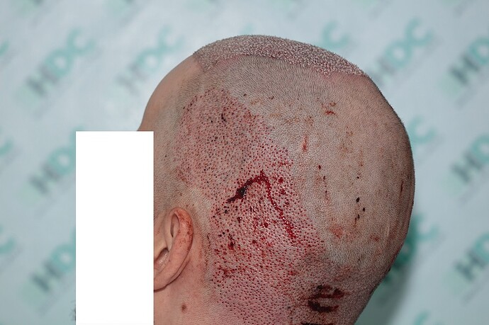 FUE Result for 4400 Grafts – 6 Months after – HDC Hair Clinic photo