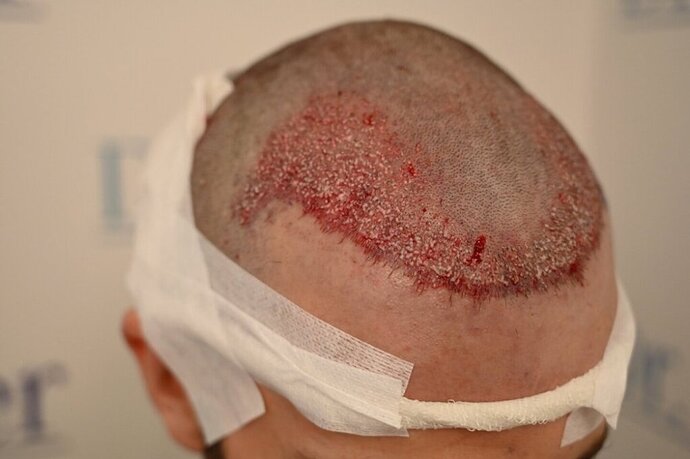 Ozlem Bicer MD-2340 Grafts FUE by micro-motor, 12. month result  photo