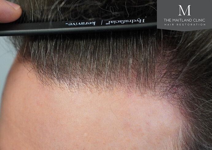 Before and after results: 1694 grafts by FUE at The Maitland Clinic (Dr Edward Maitland Ball) photo