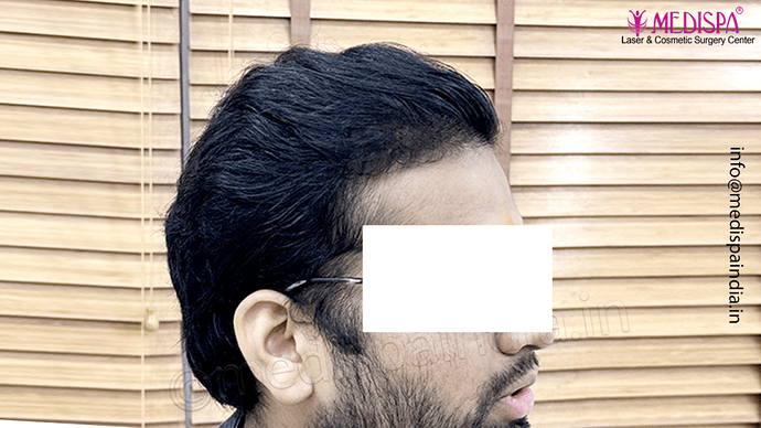 Dr. Suneet Soni - 5467 Grafts, Combine FUT + FUE + Beard Technique, NW- V, 3 Years Result photo