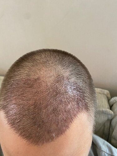 Dr.Bisanga, BHR Clinic Brussels 3251 FUE 0 - 8 Months photo