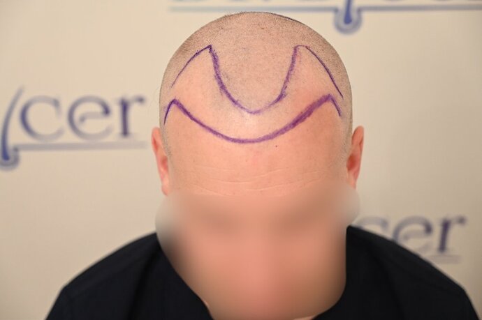 Ozlem Bicer MD-Hair Transplant-2720 Grafts FUE by micro-motor, 9. months result photo