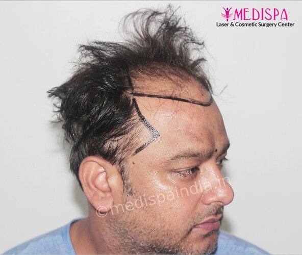 Dr. Suneet Soni - 5000 Grafts, Combine FUT + FUE + BHT (Beard) Technique, NW-V, 2.5 Year Result photo