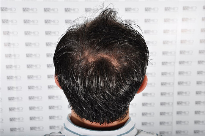 ASMED by Dilek Cakir - 4033 graft - Combo Micro & Manual FUE photo