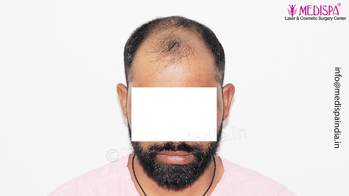 Dr. Suneet Soni - 5360 Grafts | 12-Month Result | Combination FUT + FUE + Beard photo