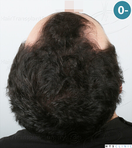 Dr. Jean Devroye, HTS Clinic / 2101 FUE / Temple corners restoration photo