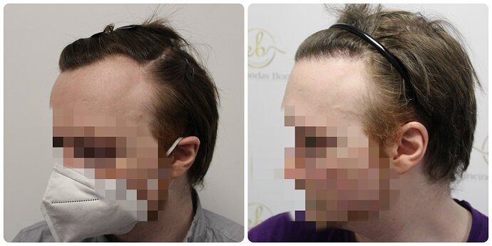 Dr Bonaros, Glasgow, UK / 1614 FUE grafts for receding Hairline / 0-12 Months photo