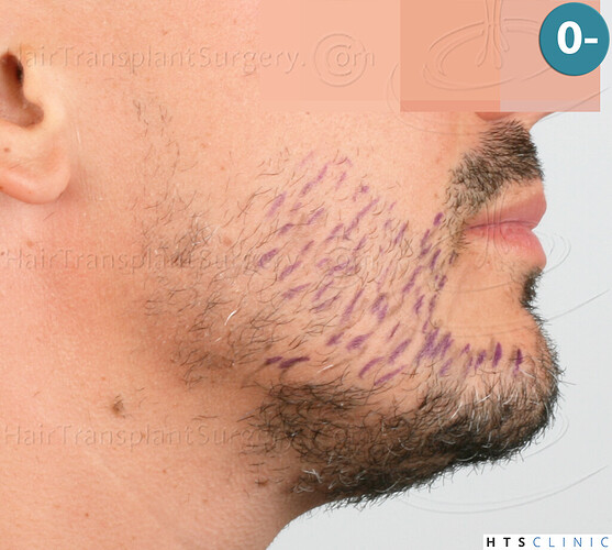 Dr. Jean Devroye, HTS Clinic / 2191 FUE (1292 + 899) / Beard restoration photo