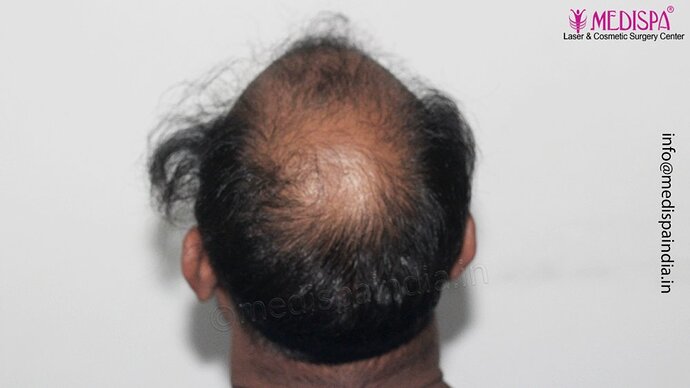 Dr. Suneet Soni - 5498 Grafts, 2 Years Result, Combine FUT + FUE + Beard Technique, NW-VI photo