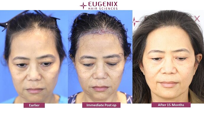 Dr. Pradeep Sethi| Eugenix Hair Sciences Clinic| 1455 Grafts | 15 Months Post-op| Female Hair Transplant photo