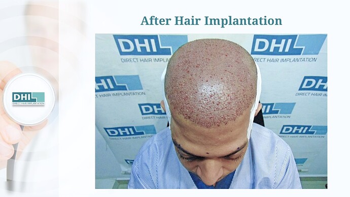 DHI India™ | 4,133 Grafts | Diffuse Alopecia | Full Coverage in 6 Months photo