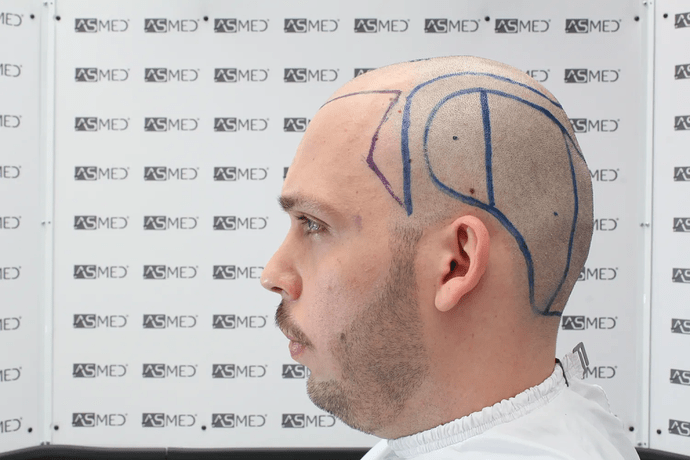 ASMED, Istanbul: 5,071 Manual FUE Grafts 0/12 Months photo