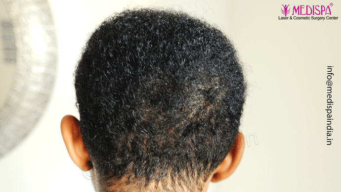 Dr. Suneet Soni - Afro Hair Transplant, 2 Sessions, 8355 Grafts, Combined FUT + FUE Technique, NW-VI, 5 Years Result photo