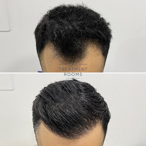Small 1274 Grafts Hairline Hair Transplant- The Treatment Rooms London photo
