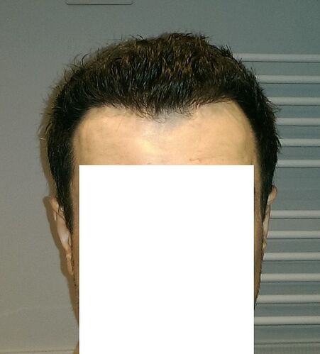Dr.Bisanga, BHR Clinic, 2519 FUE 0 - 6 Months photo