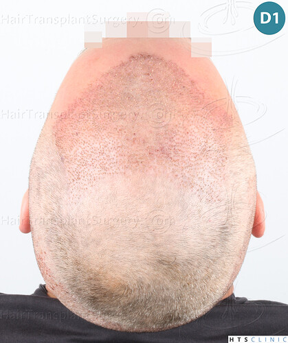 Dr Devroye + Dr Montesanti + Dr Jenard, HTS Clinic / 2932 FUE / Hairline & frontal area photo