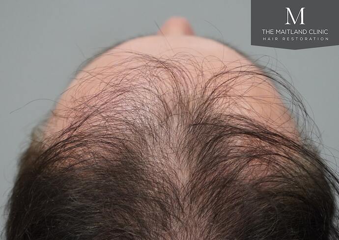 Dr Ball - The Maitland Clinic 2032 Grafts By FUE photo