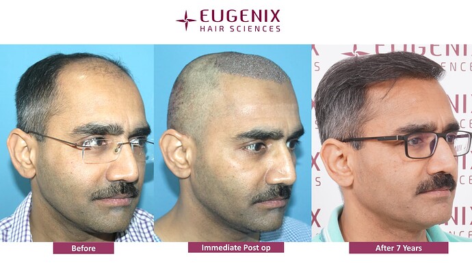 hair-transplant-before-after-9