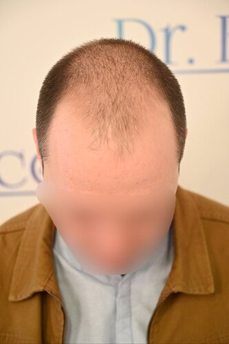 Ozlem Bicer MD-Hair Transplant-3980 Grafts FUE by micro-motor, 12. months result photo