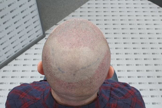 ASMED CLINIC - DR.KORAY - 5060 GRAFTS FUE photo