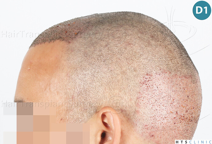 Dr Devroye + Dr Montesanti + Dr Jenard, HTS Clinic / 2018 FUE / Hairline & frontal area photo