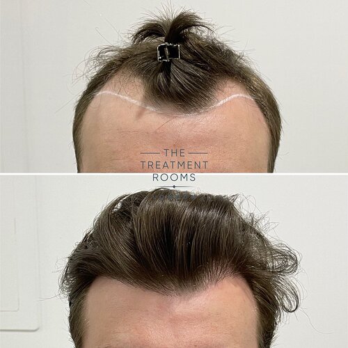 1357 Grafts Hairline & Temple Restoration photo