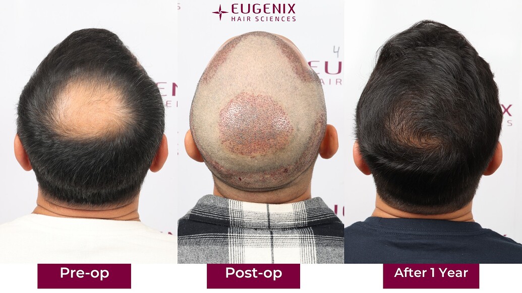 https://cdn.forumhairtransplant.com/optimized/3X/1/7/170cdd790debccc7e908c9192ae9d52822bdc093_2_1035x582.jpeg