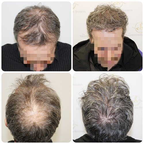 Dr Bonaros, Glasgow, UK / 3595 FUE grafts / 0-12 Months photo