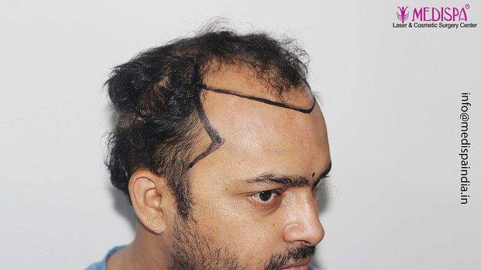Dr. Suneet Soni - 5000 Grafts, Combine FUT + FUE + Beard Technique, NW-V photo