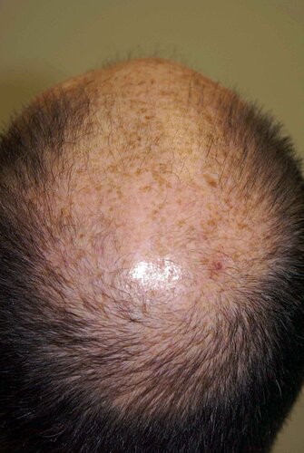 Dr B Farjo 2000-2023 Patient using both FUT and FUE, photo