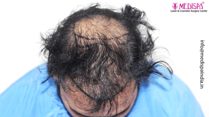 Dr. Suneet Soni - 5467 Grafts, Combine FUT + FUE + Beard Technique, NW- V, 3 Years Result photo