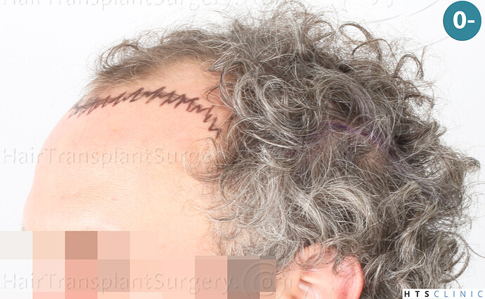 Dr Devroye + Dr Montesanti + Dr Jenard, HTS Clinic / 2932 FUE / Hairline & frontal area photo