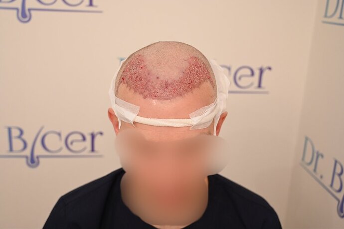 Ozlem Bicer MD-Hair Transplant-2720 Grafts FUE by micro-motor, 9. months result photo