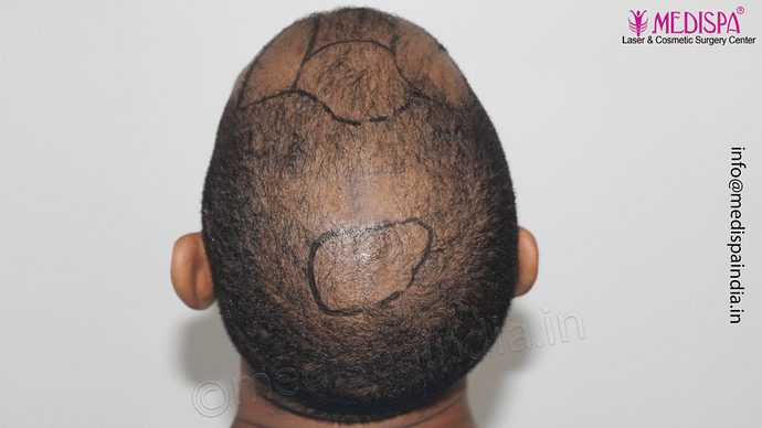 Dr. Suneet Soni - Afro Hair Transplant, 2 Sessions, 8355 Grafts, Combined FUT + FUE Technique, NW-VI, 5 Years Result photo