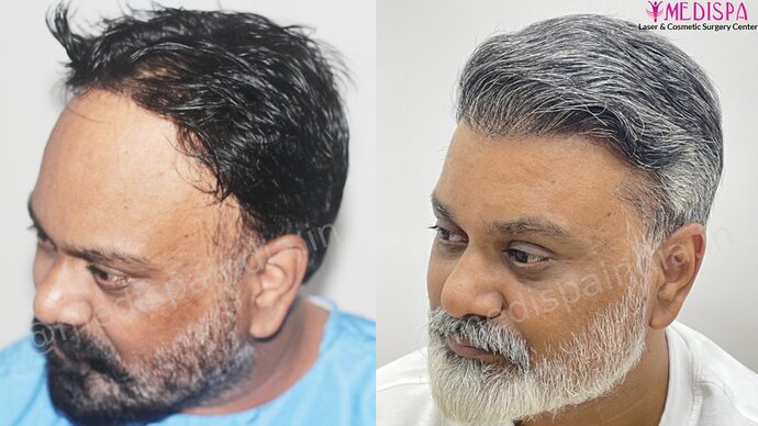 Dr. Suneet Soni - 4190 Grafts, Combine FUT + FUE + Beard Technique, NW- III photo