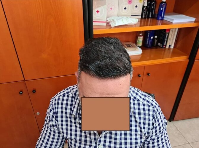 3567 FUE grafts for NW4 paitent by Dr. Maras at HDC clinic photo