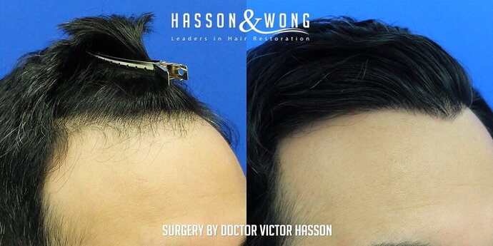 Dr. Hasson / 2,500 grafts / FUE / Hairline / 1 Year Post-op photo