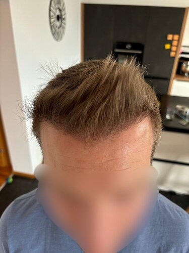 Ozlem Bicer MD-Hair Transplant-2720 Grafts FUE by micro-motor, 9. months result photo