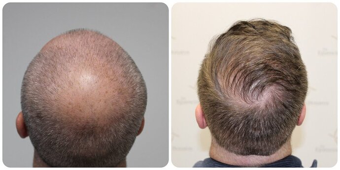 Dr Bonaros, Glasgow, UK / 4076 FUE grafts / 0-12 Months photo