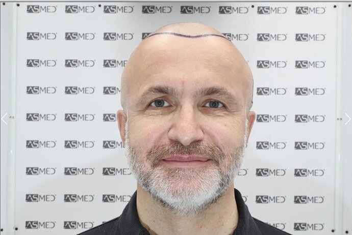 Asmed Clinic - FUE Hair Transplant - 5041 Grafts photo