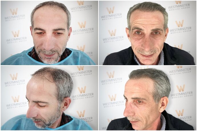 Westminster Medical Group London - 2407 Grafts - 12 Months Progress photo