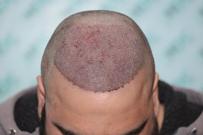 Density Enhancement Result for 4516 FUE Grafts – HDC Hair Clinic – 1 Year Post-Procedure photo