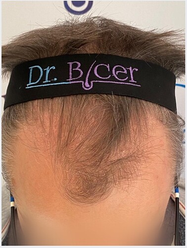 Ozlem Bicer MD-Hair Transplant-3770 Grafts FUE by micro-motor, 8. months result photo