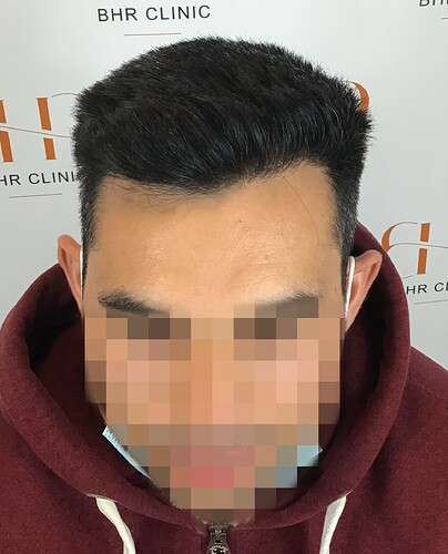 Dr. Bisanga BHR Clinic - 2350 FUE 0 – 12 Months with Photos and Video photo