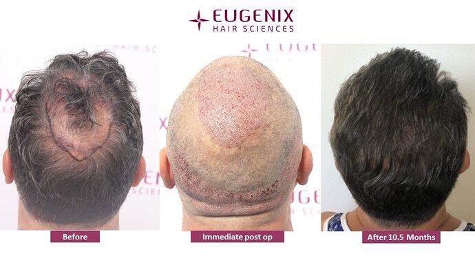 Hair Transplant in case of Diffuse thinning. photo